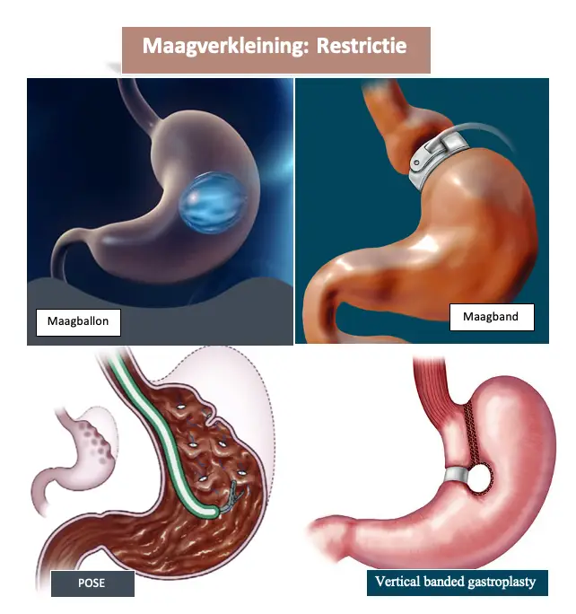 Maagverkleining: voor- en nadelen