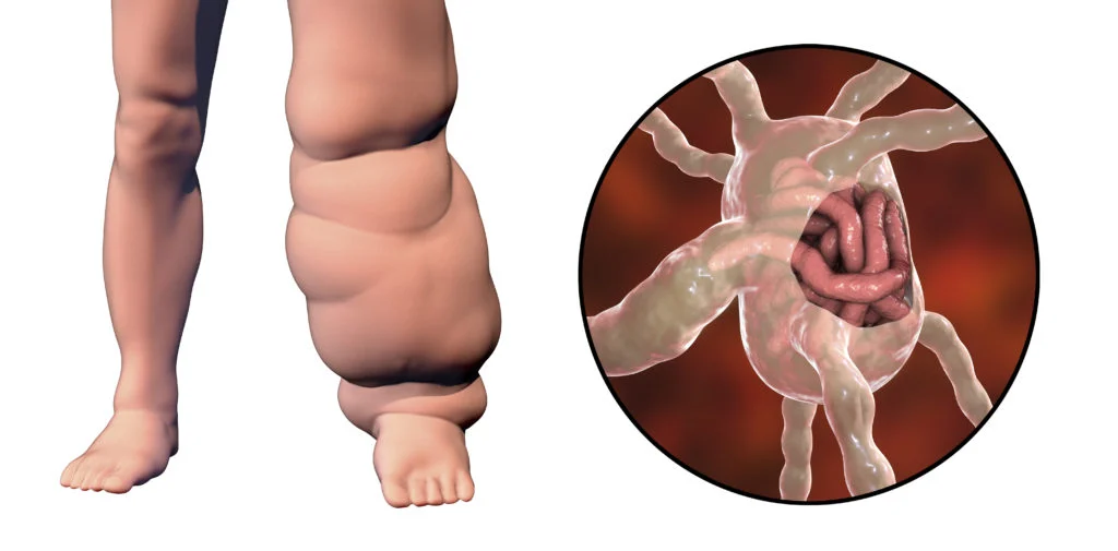 Lymfoedeem