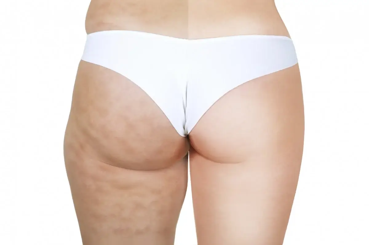 Een cellulitis vrije zomer? Dat kan!